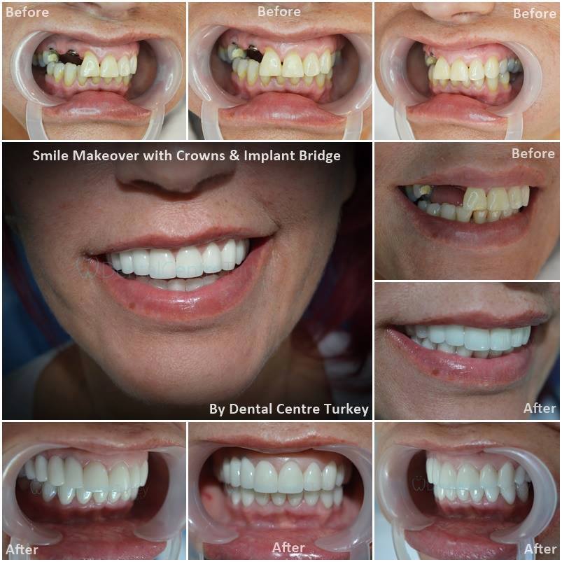 dental implants dentist in istanbul