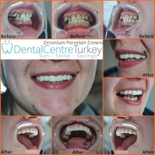 Dental Restoration Istanbul