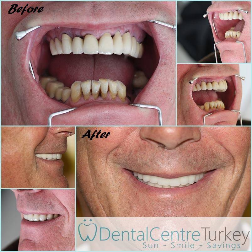 dental implants dentist in istanbul