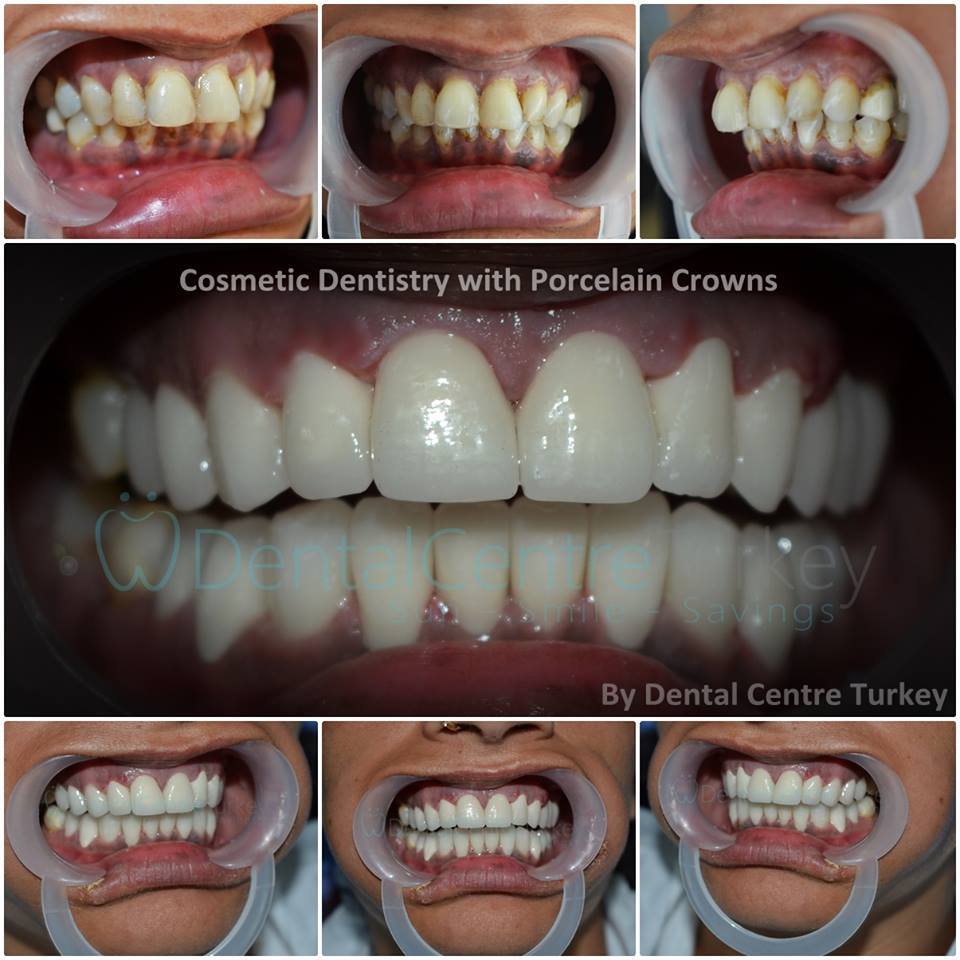 dental crowns dentist in istanbul