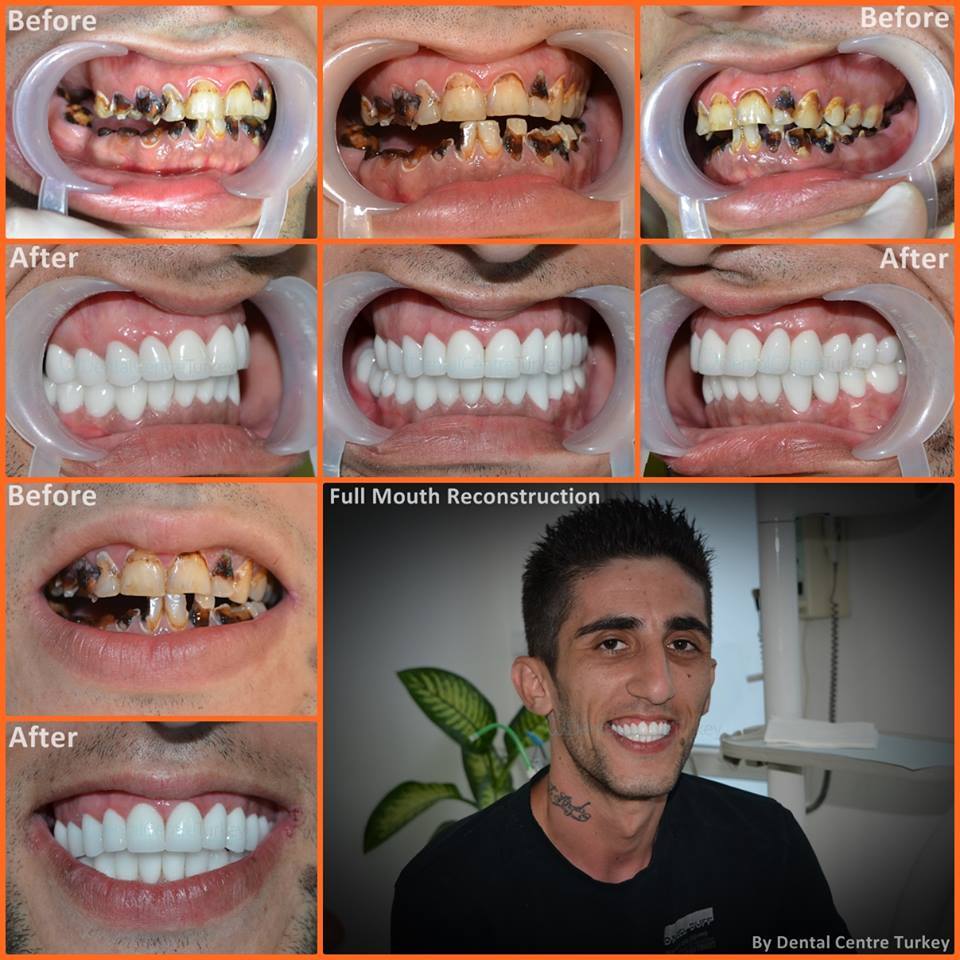 dental crowns istanbul dentist in istanbul