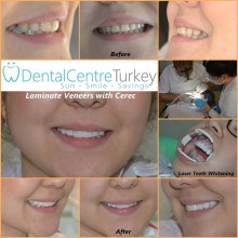 Dental veneers in Istanbul