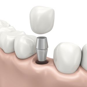 DENTAL IMPLANTS ECAMPLES ISTANBUL