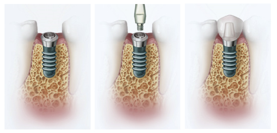 dental implant istanbul examples