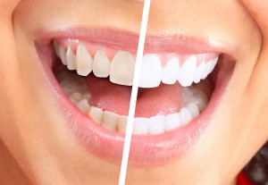 teeth whitening istanbul